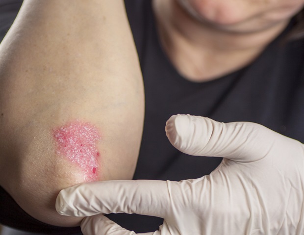 At-home phototherapy proves effective for psoriasis treatment