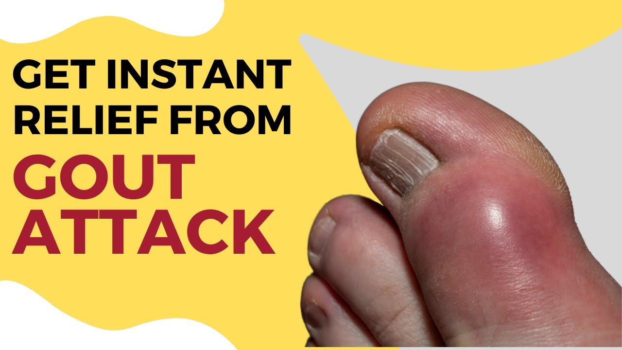 Get Instant Relief From Gout Attack | Homeopathy Treatment