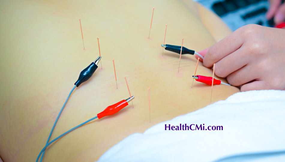 Acupuncture Sciatica And Herniated Disc Relief Found