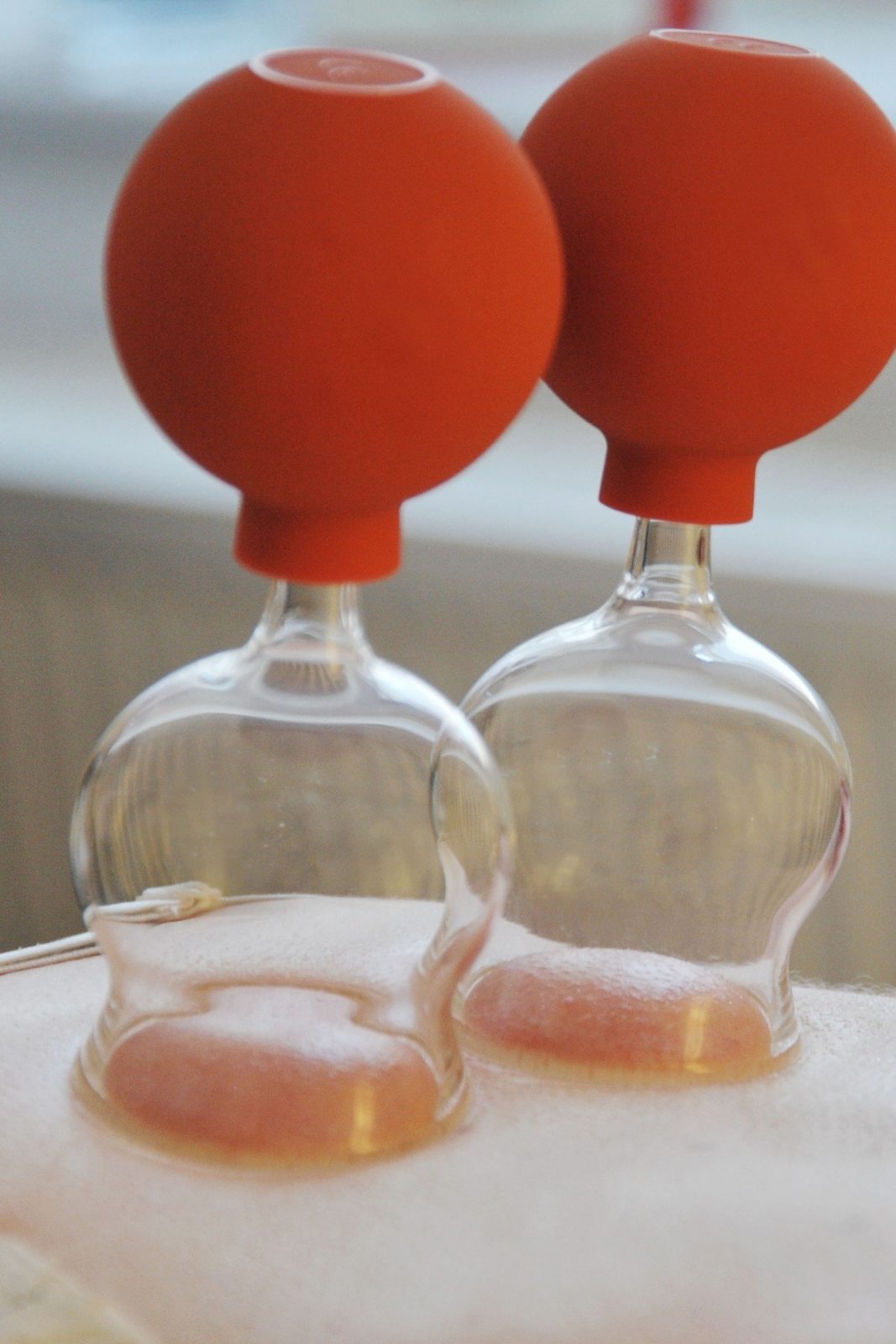 CUPPING and the Acupuncture Meridians