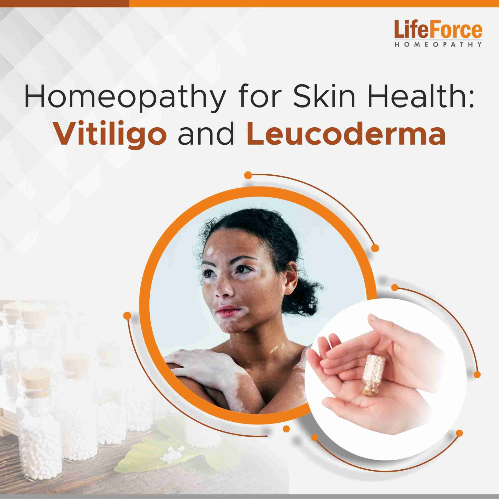 Homeopathy for Skin Health: Vitiligo and Leucoderma