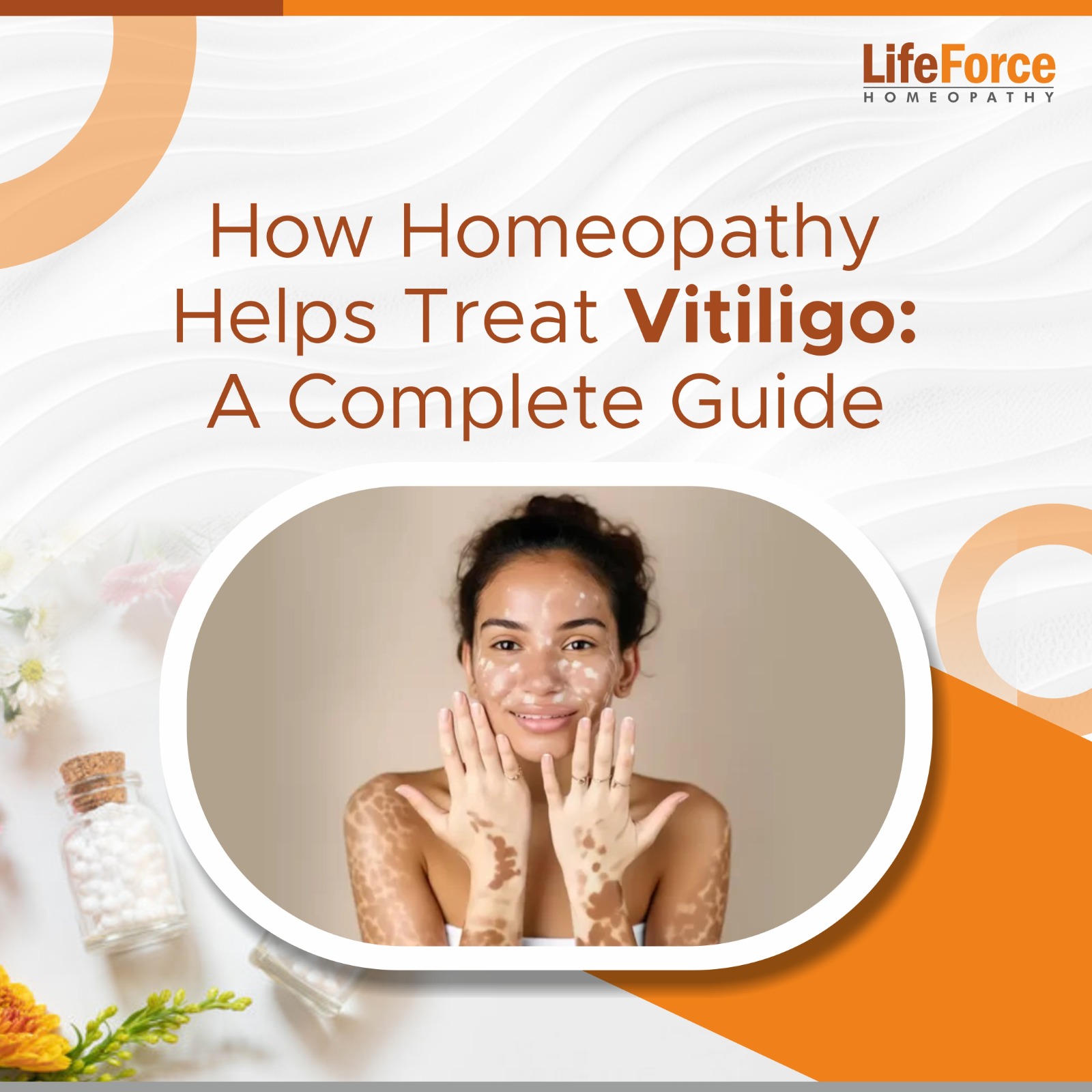 How Homeopathy Helps Treat Vitiligo: A Complete Guide