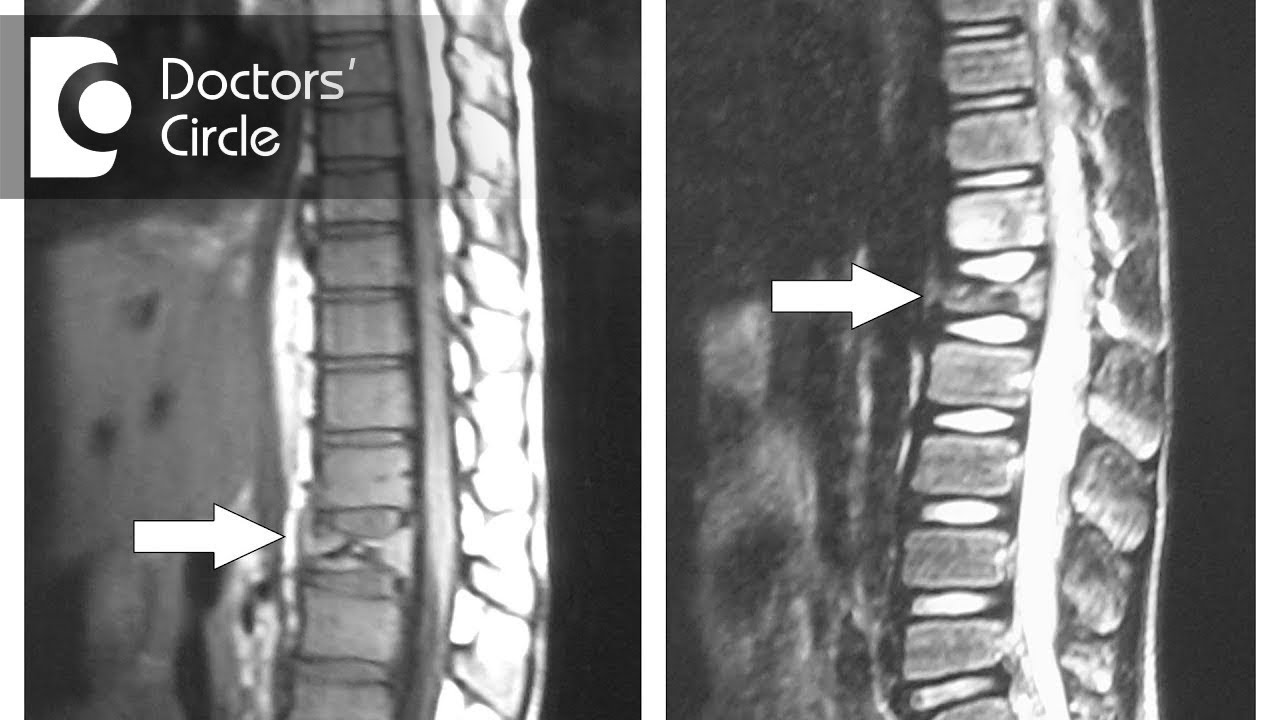 How can one manage Spinal Tuberculosis & abscess with homeopathy?  – Dr. Surekha Tiwari