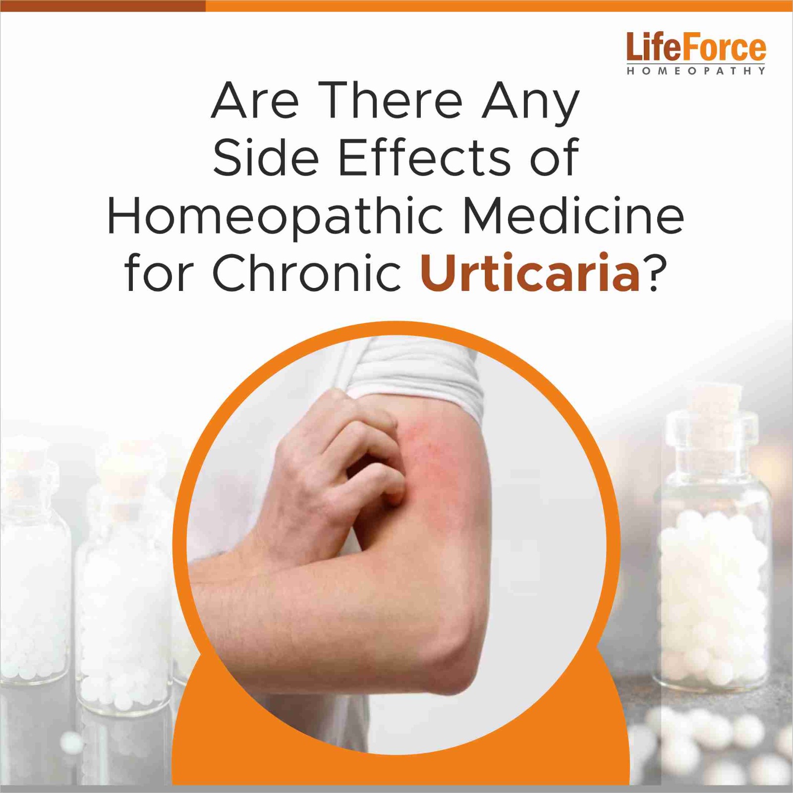 Are There Any Side Effects of Homeopathic Medicines for Urticaria